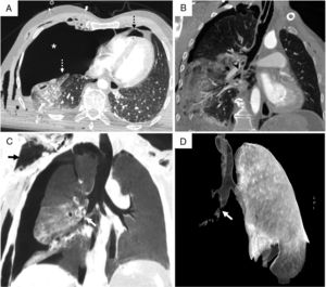 TC de tórax con contraste intravenoso: A) Plano axial, ventana de pulmón. Signo del pulmón caído (flecha blanca discontinua) por colapso y desplazamiento del hilio pulmonar hacia partes declives. Se observa también neumotórax derecho a tensión (asterisco blanco) que condiciona desplazamiento mediastínico contralateral y neumopericardio (flecha negra discontinua). B) Reconstrucción coronal, ventana de pulmón. Neumomediastino con aire rodeando los bronquios y los vasos pulmonares de disposición paralela a los mismos en el hilio pulmonar (cabeza de flecha negra). C) Reconstrucción multiplanar con proyección de mínima intensidad (MiniP), plano coronal, ventana de pulmón donde se identifica enfisema subcutáneo (flecha negra continua) y discontinuidad de la vía aérea (flecha blanca). D) Reconstrucción volumétrica 3D, proyección anteroposterior con supresión de pulmón derecho. Laceración del bronquio intermediario con amputación bronquial y discontinuidad de la vía aérea (flecha blanca).