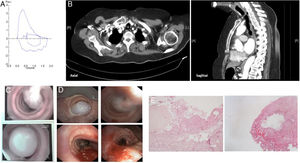 Spirometry flow-volume loop (A) was not typical of an extrathoracic obstruction. CT-scan axial and sagittal images (B) show a pedicled lesion in middle third of the trachea. Images of flexible bronchoscopy (C) and rigid bronchoscopy (D) before and after argon-plasma therapy and mechanical debridement with en bloc removal of the lesion. Histological images of polypoid fibroma of the tracheal mucosa [hematoxylin and eosin staining] (E).