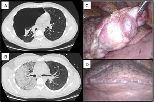 A y B) TAC: muestra el neumotórax completo y el patrón en vidrio esmerilado unilateral. C y D) Hallazgos intraoperatorios: ampolla (blebs).