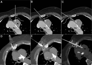 A) Imagen axial de TC de tórax con contraste intravenoso en la que se observa una masa paraaórtica en mediastino anterior (asterisco). La flecha recta describe el trayecto teórico de la aguja de biopsia en un abordaje paraesternal izquierdo entre los vasos mamarios internos izquierdos (círculo) y el borde izquierdo del esternón. Nótese que el cayado aórtico (Ao) se encuentra en el trayecto teórico de la aguja de biopsia. La flecha curva indica que en este acceso se punciona el parénquima pulmonar izquierdo. B) Imagen axial de TC de tórax con contraste intravenoso en la que la flecha recta describe el trayecto teórico de la aguja de biopsia en un abordaje paraesternal derecho medial a los vasos mamarios internos derechos (círculo). Nótese que el cayado aórtico (Ao) no se encuentra en el trayecto teórico de la aguja de biopsia, pero que con este abordaje se punciona también el parénquima pulmonar izquierdo (flecha curva). C) Imagen axial de TC de tórax con contraste intravenoso en la que la flecha recta describe el trayecto teórico de la aguja de biopsia en un abordaje paraesternal derecho lateral a los vasos mamarios internos derechos (círculo). Nótese que el cayado aórtico (Ao) tampoco se encuentra en el trayecto teórico de la aguja de biopsia, pero que con este abordaje se punciona el parénquima pulmonar derecho (flecha curva). D) Imagen axial de TC de tórax obtenida durante el procedimiento de biopsia mediante APEC, con la paciente en posición de semidecúbito lateral derecho, en la que se visualiza una aguja intramuscular (flechas) entre los vasos mamarios internos derechos (círculo) y el margen derecho del esternón para la instilación local de suero salino (hidrodisección). E) Imagen axial de TC de tórax obtenida durante el procedimiento de biopsia mediante APEC, con la paciente en posición de semidecúbito lateral derecho, en la que una vez expandido el mediastino anterior mediante la técnica de hidrodisección (flechas blancas) se introduce la aguja de biopsia (flechas negras) en la pared torácica. Nótese que la aguja de biopsia se dirige hacia el espacio existente entre los vasos mamarios internos derechos (círculo) y el borde derecho del esternón. F) Imagen axial de TC de tórax obtenida durante el procedimiento de biopsia mediante APEC, con la paciente en posición de semidecúbito lateral derecho, en la que se ha progresado la aguja de biopsia (flechas) hasta la masa paraaórtica (asterisco negro) a través del espacio entre el borde derecho del esternón y los vasos mamarios internos derechos (círculo). Nótese la presencia del «salinoma» (asterisco blanco) en el mediastino anterior y la imposibilidad de lesionar la aorta (Ao) debido a la trayectoria paralela de la aguja de biopsia al cayado aórtico.