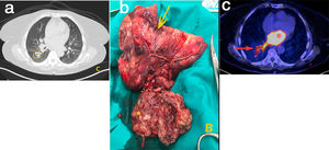 (A) PET/CT image showing a hypermetabolic mass extending from the pulmonary vein (arrow) to the left atrium (asterisk). (B) Right lower lobectomy (arrow) with intra-atrial mass (arrow). (C) CT scan showing multiple parenchymal metastases.