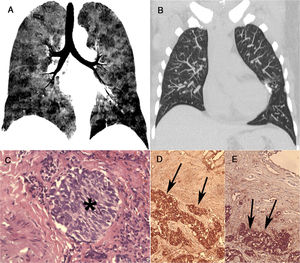 A coronal minimum-intensity projection reformatted image (A) demonstrates mosaic attenuation with sharply defined lobular areas of low attenuation due to small airway obstruction (consistent with air trapping). A coronal maximum-intensity projection image (B) shows multiple bilateral small nodules, probably corresponding to tumorlets. A histopathological section (C) demonstrates a nodular aggregate (tumorlet) (asterisk) of atypical oval cells (hematoxylin and eosin staining, ×100). The tumoral cells expressed immunohistochemical positivity for synaptophysin (arrows) (D) and chromogranin A (arrows) (E), characterizing neuroendocrine cell proliferation.