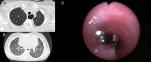 A) TCAR: defecto de continuidad de la pars membranosa traqueal; B) TCAR: opacidades centroacinares compatibles con microaspiraciones; C) Fibrobroncoscopia: burbujeo y paso de azul de metileno, instilado a través de esófago, a tráquea.