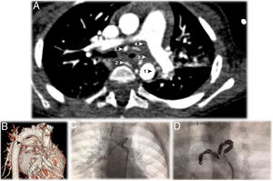 A – Thoracic computed tomography angiography (CTA), in axial plane, showing the anomalous artery, originating in the right side of the descending thoracic aorta (AoD), encircling the left main bronchus at the point of bronchial stenosis. The anomalous bronchial artery originates two bronchial arteries, right and left. The five arrows point to 1: the origin at the aorta; 2: the first branch, which is a normal right intercostobronchial branch; 3: the second branch, which is an aberrant bronchial trunk; 4 and 5: the two vessels originate from the bronchial trunk to form right and left bronchial arteries. B – Computerized tomography reconstruction arteriography view showing the tortuosity of the anomalous bronchial artery described in a (). C – Dynamic image showing the anomalous bronchial artery tortuous path around the left main bronchus. D – Endovascular embolization of the abnormal vessel, occluded with 12 microcoils.