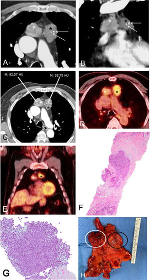 A) y B) Imágenes axial (A) y coronal (B) de TC de tórax en las que observan dos masas en mediastino anterior: una masa derecha (asterisco blanco) y una masa izquierda (asterisco negro). Nótese la presencia de focos de calcificación en la masa izquierda (flechas). C) Imagen axial de TC de tórax en la que se aprecia claramente la diferente atenuación de las masas mediastínicas: la masa derecha (asterisco blanco) presenta una atenuación media de 83 unidades Hounsfield mientras que la masa izquierda (asterisco negro) presenta una atenuación media de 54 unidades Hounsfield, sugiriendo un origen independiente. D) y E) Imágenes axial (D) y coronal (E) de PET/TC en las que se aprecia la diferente actividad metabólica de las dos masas mediastínicas (mayor avidez por la FDG por parte de la masa izquierda [6,1, asterisco negro] que por parte de la masa derecha [3,6, asterisco blanco]), sugiriendo dos tumores independientes. F) Muestra obtenida mediante biopsia percutánea de la masa mediastínica izquierda en la que observa una proliferación neoplásica de células epiteliales rodeadas de un tejido fibroso y sin apenas linfocitos, en relación con un timoma B3 (hematoxilina y eosina). G) Muestra obtenida mediante biopsia percutánea de la masa mediastínica derecha en la que se identifica un componente linfocitario mayoritario con algunos nidos de células epiteliales prominentes, en relación con un timoma B2. H) Pieza macroscópica postquirúrgica en la que se observan las dos masas contiguas (el círculo blanco corresponde a la masa derecha mientras que el círculo negro corresponde a la masa izquierda). FDG: fluorodesoxiglucosa; PET/TC: tomografía por emisión de positrones; TC: tomografía computarizada.