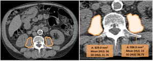 This is one example showing how the psoas measurement was performed in a participant from the COPD group. A region of interest (ROI) was manually traced involving all the psoas muscle. No special imaging post-processing was required.