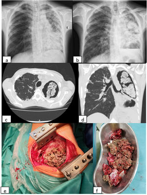 (a, b) X-ray evolution of the patient. The X-ray on the left (a) was performed before corticosteroids therapy and the one on the right (b) about seven months after the beginning of that therapy; (c, d) coronal and axial views of thoracic computed tomography performed after six months of Itraconazole, showing giant aspergilloma in left lung; (e, f) necrotic material of fungus ball observed during surgery.
