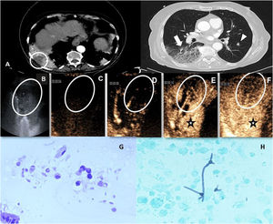 A) TC tras la administración de contraste yodado intravenoso. Se muestran cortes axiales en ventana de mediastino (izquierda) y de parénquima pulmonar (derecha) donde se observa una consolidación heterogénea en el lóbulo inferior derecho con áreas hipocaptantes (círculo) junto con zonas en vidrio deslustrado y árbol en brote (flecha). Adicionalmente existen algunos nódulos sólidos pulmonares bilaterales (cabeza de flecha) en probable relación con metástasis. B) Ecografía en modo B practicada en el mismo paciente donde se visualiza una consolidación heterogénea sin broncograma aéreo y un área subpleural anecoica (elipse). C-F) Imágenes ecográficas tras la inyección de contraste ecográfico identificando un realce homogéneo, aunque retrasado (estrella) del parénquima pulmonar consolidado (patrón neumónico). Adicionalmente, se observa un área de morfología triangular subpleural cuyo realce es más retrasado respecto al parénquima consolidado circundante (oval). Además, muestra un lavado precoz, hallazgos sugestivos de malignidad. Se realizó posteriormente biopsia guiada con ecografía sobre el área sospechosa con resultados histológicos de metástasis de adenocarcinoma pancreático. Posteriormente, una fibrobroncoscopia confirmó la infección fúngica sobreañadida en el parénquima circundante. G) Grupos de células epiteliales grandes atípicas y vacuoladas en relación con metástasis de adenocarcinoma pancreático. H) Análisis microbiológico de la muestra de lavado broncoalveolar en el área consolidativa donde se observan estructuras ramificadas correspondientes a hifas.