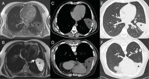 A-F) Quiste pleuropericárdico migratorio: A) Imagen axial de la RM potenciada en T1 en la que se evidencia una lesión hipointensa (asterisco) a nivel de la cisura izquierda. B) Imagen axial de la RM potenciada en T2 en la que se evidencia lesión hiperintensa (asterisco) a nivel de la cisura izquierda con extensión hacia el pericardio (flecha). C) Imagen axial de la TC obtenida en decúbito supino donde se observa una lesión de densidad líquida (asterisco). D) Imagen axial de la TC obtenida en decúbito prono donde se observa una lesión de densidad líquida (asterisco) con desplazamiento hacia anterior respecto al decúbito supino. E) Imagen axial de la TC obtenida en decúbito supino en ventana de pulmón donde se observa que la lesión (asterisco) se encuentra en.