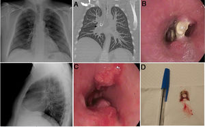 Radiografía de tórax posteroanterior y lateral sin alteraciones. A) Reconstrucción en TC de tórax con visión de la anilla en el bronquio intermediario (flecha) en corte coronal. B) Extremo proximal de la anilla enclavada en el tercio distal del bronquio intermediario. C) Visión endoscópica tras retirada de la anilla con persistencia de tejido de granulación proximal y distal formando un tabique. D) Anilla.