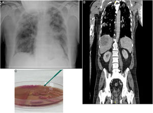 A: Radiografía de tórax al ingreso: infiltrados pulmonares bilaterales compatibles con bronconeumonía. B: TAC toracoabdominal, corte coronal mostrando absceso hepático e infiltrados pulmonares bilaterales. C: Placa agar MacConkey: crecimiento de colonias de Klebsiella pneumoniae hipermucoviscosa.