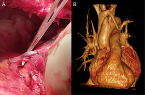 La imagen «a» muestra el DVPAP cabalgando sobre la arteria pulmonar principal izquierda. La imagen «b» muestra la reconstrucción volumétrica de los vasos pulmonares izquierdos y muestra el DVPAP drenando en el tronco braquicefálico izquierdo.