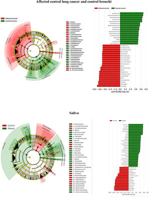 Streptococcal abundance (A); ROC curves of the relative Streptococcus abundance to discriminate patients from controls (B), and distance between saliva and lung microbiota in controls and in patients (C).