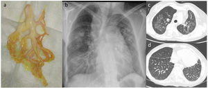 a) Molde bronquial expectorado por la paciente. b) Radiografía de tórax posteroanterior en la que se objetivan infiltrados multilobares en ambos campos pulmonares. b) Tomografía computarizada torácica en la que se visualizan múltiples opacidades parenquimatosas en vidrio deslustrado con distribución geográfica en ambos campos pulmonares. c) Tomografía computarizada torácica con engrosamiento liso de los septos interlobulillares en ambos lóbulos inferiores que en el contexto de síndrome de Noonan sugieren la presencia de displasia linfática.