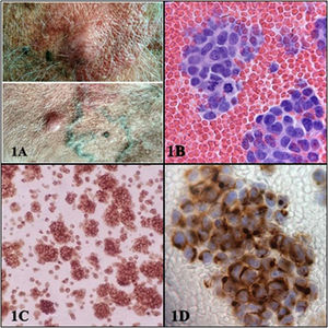 A)Lesiones cutáneas sobreelevadas en la cara anterior de tronco. B)Estudio citológico del líquido pleural que muestra una población celular monomorfa de células redondas, azules, pequeñas, con escaso citoplasma y un patrón cromatínico en «sal y pimienta». Se identifican numerosas células en mitosis (bloque celular H-E, ×40). C)Estudio inmunohistoquímico con expresión de sinaptofisina (marcador neuroendocrino). Muestra una expresión de patrón punteado paranuclear granular fino (SYN, ×20). D)Estudio inmunohistoquímico que muestra positividad para citoqueratina20 con patrón de tinción perinuclear «dot like» en el 100% de las células neoplásicas, específico del carcinoma de células de Merkel (CK-20, ×40).