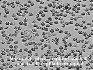 Montaje en placa de amplitud 400x de muestra de cepillado bronquial.