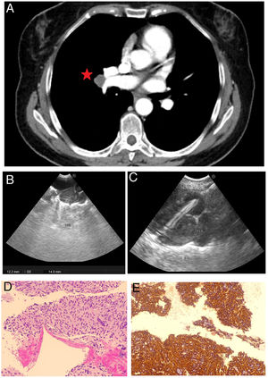 A) Imagen de la tomografía axial computarizada con presencia de adenopatía en TA hiliar derecho. B) Imagen del territorio adenopático 11R mediante ecobroncoscopia. C) Punción transvascular mediante ecobroncoscopia. D) Imagen histológica a 20 aumentos de tinción con hematoxilina-eosina que muestra una proliferación celular fusiforme con atipias. E) Imagen histológica a 20 aumentos que demuestra positividad para actina músculo específica.