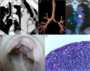 Coronal (A) and sagittal (B) reformatted images and a three-dimensional external rendering (C) of a chest computed tomography image show nodular lesions in the trachea and left main bronchus, with irregular luminal narrowing and severe stenosis. (D) 18F-fluorodeoxyglucose positron emission tomography/computed tomography demonstrated increased fluorodeoxyglucose uptake in the left main bronchus, with a maximum standard uptake value of 8.4. (E) Fiberoptic bronchoscopy revealed multiple small nodular mucosal lesions with a cobblestone appearance along the trachea and left main bronchus. (F) A histopathological section demonstrating the proliferation of atypical small lymphoid cells, compatible with lymphoma (hematoxylin and eosin stain, 100× magnification).
