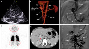 (A) Echocardiography. Four chamber view depicting a shaked serum. After three cardiac cycles the left atrium was also opacified. (B) Nuclear scanning with Technetium 99m macro-aggregated albumin. A part from the lungs, brain and kidney also showed radioactivity due to tracing uptake (red circles). (C) CT Angiogram. 3D Volume rendering showing the Abernethy malformation. (D) CT Angiogram: Axial plane illustrating the Abernethy shunt (red arrow). (E) Fluoroscopy. Left oblique projection. The centimetered catheter reaches the portal vein from the inferior vena cava, through Abernethy shunt (asterisk). (F) Fluoroscopy. Antero-posterior projection. Balloon shunt occlusion test. Abbreviations: Abd Ao: abdominal aorta. IMS: inferior mesenteric vein. IVC: inferior vena cava. LA: left atrium. PV: portal vein. RA: right atrium. SMV: superior mesenteric vein. SP: splenic vein.