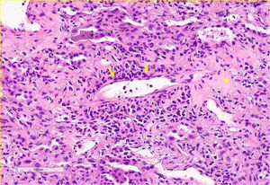 Vaso de pequeño calibre con infiltrado inflamatorio subendotelial (flechas). La histología mostró una extensa fibrosis con depósitos de colágeno (estrella). Tinción: hematoxilina-eosina. 20x.