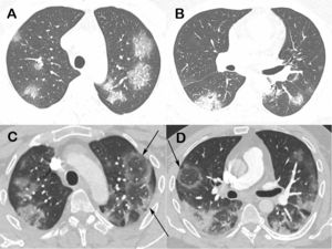Chest computed tomography images of a 48-year-old man with confirmed COVID-19 pneumonia. Images obtained at the levels of the upper (A) and lower (B) lobes 2 days after symptom onset show bilateral round and oval ground-glass opacities. Enhanced images (C and D) obtained at the same levels as A and B 3 days later show multiple reversed halo signs (arrows) in both lungs.