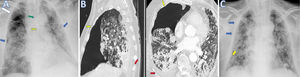 (A) Chest X-ray (anteroposterior projection) performed on day 24 from the admission showed bilateral peripheral opacities (blue arrow) and a right upper pneumothorax (white arrow). Endotracheal tube (green arrow) and left internal jugular central venous access with distal end at the level of the superior vena cava (SVC) (yellow arrow)are well placed. (B) CT scan on sagittal and trasverse planes images shows confirmed a right upper-anterior pneumothorax with partial collapse of the right upper lobe (yellow arrows) associated with mild right posterior pleural effusion (red arrows). (C) Chest X-ray with single anteroposterior projection scan obtained on day 26, after positioning of inferior right pleural drainage (yellow arrow), shows resolution of pneumothorax with riexpansion of the right lung (blue arrow).