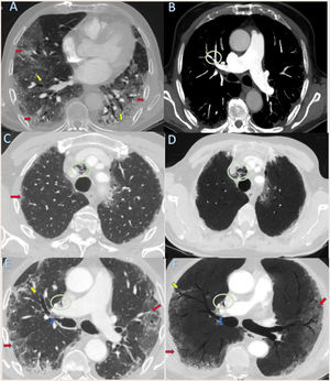 (A) Transverse CTPA images obtained with lung window setting shows multiple pulmonary parenchymal mainly peripheral ground glass opacities (red arrows). Bilateral varicose bronchiectasis (yellow arrows). (B) Maximum intensity projection (MIP) reconstructions images in axial plane shows filling defects (green circle) at the bifurcation level of the anterior segmental branch in right upper lobe compatible with pulmonary thromboembolism. (C–F) Transverse CT images with lung window (C and E) and reformatted Minimum intensity projection (MinIP) reconstructions (D and F) obtained at upper and medium mediastinic levels shows pulmonary interstitial emphysema with air tracking along the right peribronchovascular sheaths ((blue arrows). Central upper anterior right pneumomediastinum (green circles) secondary to a spontaneous barotrauma (Macklin effect). Multiple parenchymal ground glass opacities with prevalent peripheral distribution (red arrows). Bilateral varicose bronchiectasis (yellow arrows).