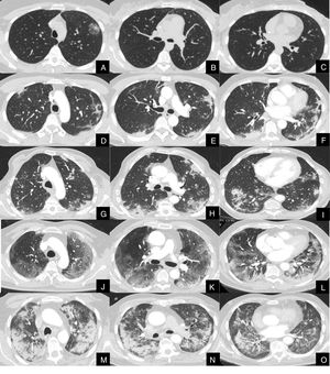 Imágenes axiales de angioTC pulmonar en ventana de parénquima a nivel de lóbulos superiores, medios e inferiores, que muestran los diferentes grados de afectación parenquimatosa en pacientes con infección respiratoria por COVID-19. A, B y C: grado muy leve. Opacidad redondeada en vidrio deslustrado con signo del halo invertido en lóbulo superior izquierdo. D, E y F: grado leve. Consolidaciones parenquimatosas subpleurales de escasa cuantía y de predominio en segmentos posteriores de lóbulos inferiores. G, H y I: grado moderado. Consolidaciones subpleurales más extensas que en el grado leve, con signo del halo invertido en lóbulo inferior derecho. J, K y L: grado severo. Vidrio deslustrado extenso con afectación de todos los lóbulos pulmonares y consolidaciones en segmentos posteriores de ambos lóbulos inferiores. M, N y O: grado muy severo. Extensas consolidaciones parenquimatosas de predominio periférico con afectación de casi la totalidad del parénquima pulmonar.