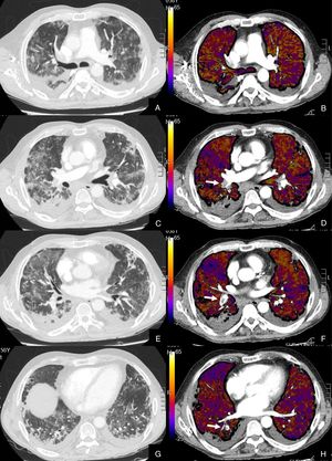 Paciente con COVID-19 con disnea, dolor torácico tipo pleurítico y elevación del D-dímero. Imágenes axiales de una angiografía pulmonar con TC y mapa de yodo, con ventana de parénquima (A, C, E, G) desde lóbulos superiores hasta lóbulos inferiores y sus correspondientes imágenes del mapa de yodo (B, D, F, H). Parénquima con extensa afectación en vidrio deslustrado y derrame pleural bilateral de pequeña cuantía. TEP unilateral en arteria lobar inferior derecha y segmentarias inferiores derechas (flechas). El mapa de yodo pone de manifiesto numerosas áreas de hipoperfusión (azules) parcheadas bilaterales (fundamentalmente en las zonas de pulmón afectado) por probable microtrombosis /alteraciones de la circulación en el lecho capilar.