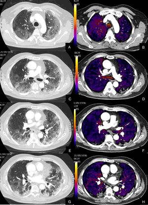 Paciente con COVID-19 que después de una semana de ingreso hospitalario persiste con desaturación que no corrige con flujo elevado de O2. Imágenes axiales de la angiografía pulmonar con TC y mapa de yodo en ventana de parénquima (A, C, E, G) desde el cayado aórtico hasta los lóbulos inferiores y su correlación con el mapa de yodo (B, D, F, H). Parénquima con afectación severa en vidrio deslustrado de predominio subpleural y segmentos posteriores de todo el pulmón, sin TEP visible. El mapa de yodo muestra una severa hipoperfusión difusa de todo el pulmón tanto afectado como sano (zonas azules y negras) en probable relación con microtrombosis difusa del lecho capilar.