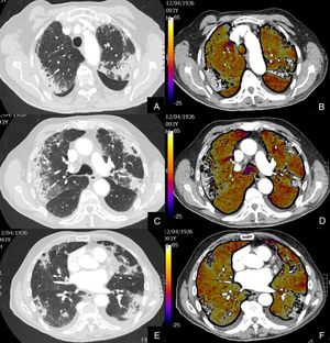 Paciente que, a pesar de buena evolución de su enfermedad por infección COVID-19, presenta elevación del D-dímero. Imágenes axiales de una angiografía pulmonar con TC y mapa de yodo, en ventana de parénquima (A, C, E) a nivel de lóbulos superiores, medios e inferiores y sus correspondientes imágenes del mapa de yodo (B, D, F). Paciente con afectación moderada por COVID-19, con consolidaciones subpleurales de predominio en segmentos posteriores y basales, sin TEP en arterias pulmonares principales ni periféricas ni defectos de perfusión en el mapa de yodo (colores amarillos, naranjas).