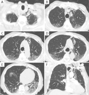 Chest computerized tomography angiography: axial images (A–E) showing pneumomediastinum associated to mild subcutaneous emphysema and peripheral ground glass opacities, mostly in the lower lobes bilaterally, but also in the upper lobes; (F) coronal reconstruction showing pneumomediastinum.