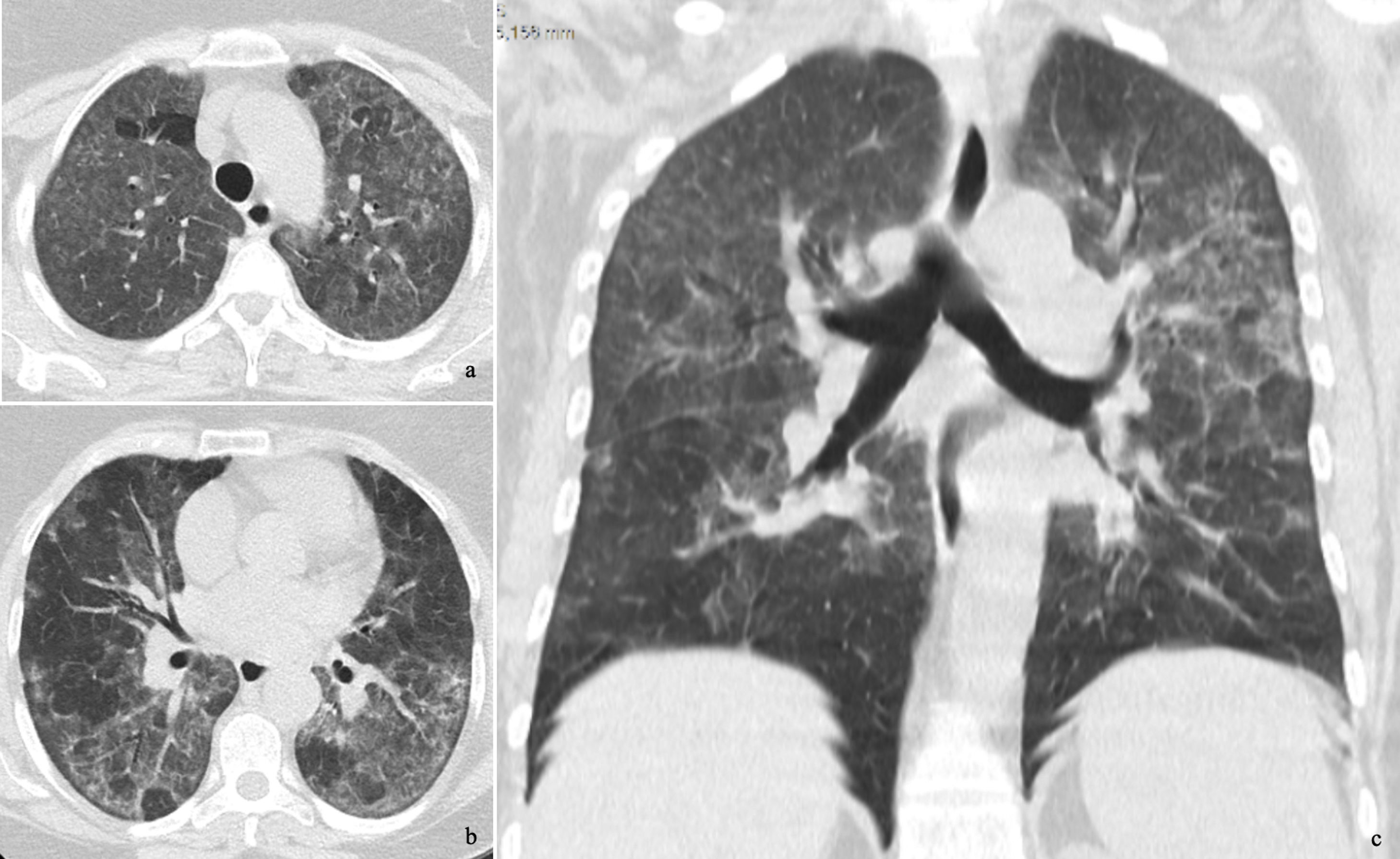 Bird Fancier's Lung Diagnosis in Times of COVID-19 | Archivos de ...