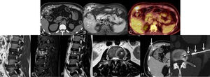 A) y B) Imágenes axiales de TC (A) y de RM (B), que muestran una lesión focal que afecta al cartílago del séptimo arco costal anterior derecho (flecha) y un aumento de partes blandas perilesional (asteriscos). C) Imagen axial de PET/TC en la que se observa un foco hipermetabólico en el cartílago del séptimo arco costal anterior derecho (flecha). D) a G) Imágenes sagitales potenciadas en T1 (D), STIR (E) y T2 (F) y axial potenciada en T2 (G) de RM de columna vertebral lumbar, en las que se identifica una lesión focal ósea en el platillo vertebral superior izquierdo del tercer cuerpo vertebral lumbar (asterisco). H) Biopsia con aguja gruesa (flecha), con control radiológico de la lesión focal del cartílago del séptimo arco costal anterior derecho con control radiológico. I) Biopsia con aguja gruesa (flechas), con control radiológico de la lesión focal ósea del tercer cuerpo vertebral lumbar.