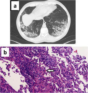 (a) CT scan showing ground glass opacities with areas of consolidation, air bronchogram and bronchiectasis; (b) Hematoxylin eosin staining (40× magnification) showing prominent lymphoplasmacytic interstitial infiltrate with numerous eosinophils. Alveoli infiltrate with mixed cellularity (lymphocytes, plasma cells, eosinophils, foamy macrophages, fibroblasts). Note one macrophage with phagocytized eosinophil granules (arrow).