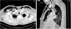 A) Corte sagital con ventana de pulmón en la que se evidencia enfisema subcutáneo que diseca planos supraclaviculares y cervicales. B) Corte axial con ventana de pulmón en la que se muestra importante enfisema en el tejido celular subcutáneo, sobre todo en la región torácica anterior, disecando los planos de la práctica totalidad de los compartimentos mediastínicos, pericardio, así como en el espacio pleural. Se muestra también la afectación pulmonar en vidrio deslustrado con discreto patrón en mosaico secundaria a infección por COVID-19.