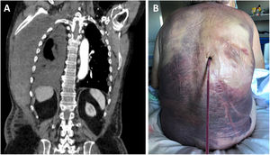 Corte coronal de la TC torácica que muestra una colección de 19×8×28cm de eje anteroposterior, transverso y craneocaudal, localizada entre la escápula y el músculo dorsal ancho y los arcos costales derechos que se extiende desde el 1.° arco costal hasta la altura de los últimos arcos costales apreciándose áreas con diferente densidad, hallazgos compatibles con hematoma de pared en diferentes estadios de sangrado (A). Imagen postoperatoria de la paciente en la que destaca la amplia extensión del hematoma superficial (B).