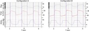 Time course of Paw, V′aw and PCO2 for configurations A and D. Paw, airway pressure; V′aw, respiratory flow; PCO2, partial pressure of CO2. Vertical purple lines: solid line, beginning of inspiration; dashed line, end of inspiration. The figure illustrates the need to increase pressure support and thus tidal volume to maintain isocapnia (38(1)mmHg). Note that the duration of PCO2 decline during inspiration in configuration D is much longer than configuration A, suggesting higher volume of CO2 rebreathed from additional instrumental dead space.