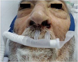 Lesiones ulceradas en fosas nasales secundarias a oxigenoterapia de alto flujo con cánula nasal y lesiones de decúbito en puente nasal provocadas por CPAP con máscara facial.