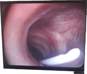 Punta de drenaje pleural a nivel de tercio superior de la tráquea.