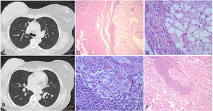 (A-B) Imagen de la TAC preoperatoria donde se aprecia la existencia de nódulos pulmonares bilaterales. A) nódulo pulmonar, subpleural, en segmento anterior del lóbulo superior derecho. B) nódulos pulmonares en lóbulo inferior izquierdo. (C-F) Imágenes histológicas del nódulo pulmonar resecado durante la cirugía. C) Se observa a la izquierda parénquima pulmonar y algún bronquiolo. A derecha un nódulo constituido por células de aspecto claro a este aumento con ribete linfocítico incompleto (variante de granuloma a cuerpo extraño). D) A mayor aumento se identifica que estas células son de hábito histiocítico y tienen un amplio citoplasma «blanco» esto es, vacío, porque en el procesamiento la silicona se disuelve, dejando el hueco. E) Granuloma a cuerpo extraño en el parénquima pulmonar cerca de una vena. F) A mayor aumento se ven los histiocitos y células gigantes multinucleadas característicos con mayor detalle.