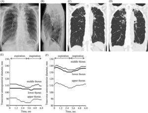 Frontal (A) and lateral (B) chest X-ray images at the age of 76. Coronal chest computed tomography images at the age of 76 (C) and 78 (D) years. Transverse anteroposterior diameter changes of images obtained by dynamic breathing magnetic resonance imaging in a patient with pleuroparenchymal fibroelastosis (E) and a healthy volunteer (F).