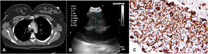 Computed tomography showed a right lower paratracheal lesion (A), endobronchial ultrasound revealed a well-circumscribed, round shaped, hypoechogenic lesion with the diameter of 11.6mm compressing the vena cava superior (B), and immunohistochemical examination showed diffuse expression of CD34 (C).