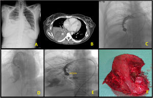 A) Rx tórax AP-Infiltrado alveolar en LID con algunas áreas radiolucentes en su interior asociado a derrame pleural. B) TC tórax con contraste endovenoso (ventana mediastino). Consolidación parenquimatosa pulmonar con colección hipodensa de pared gruesa y realzada en relación con absceso de 6 cm (neumonía necrotizante) y derrame pleural. Lesión de morfología sacular, de 14 mm, en relación con pseudoaneurisma mucormicótico. C) Arteriografía diagnóstico-terapéutica. Lesión de morfología sacular en relación con pseudoaneurisma dependiente de la rama inferior del segmento medial del LID. D) Pseudoaneurisma de menor tamaño respecto a figura C y extravasación del contraste en relación con rotura. E) Embolización mediante dispositivo Amplatzer (flecha negra) y colocación de coils (flecha amarilla) en rama arterial del segmento inferomedial del LID. F) Pieza quirúrgica tras lobectomía inferior derecha. Se observa cavidad necrótica y dispositivo Amplatzer (flecha). AP: Anatomía Patológica; LID: lóbulo inferior derecho; Rx: rayos x; TC: tomografía computarizada.