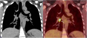 (A) Coronal reformatted CT image shows a well define nodule in the intermediate bronchus. (B) Integrated FDG-PET/CT shows intense uptake within the tumour (arrow). Standarized uptake value maximum (SUVmax): 6.5.