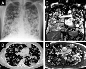 Bilateral multiple, bilateral, rounded, well-defined lesions are seen in posteroanterior chest radiograph (A), axial plane of CT study in maximum intensity projection (B) and MRI images of steady-state free precession sequence in coronal and axial plane (C, D). The chest radiograph was acquired a year prior to the CT and MRI studies.