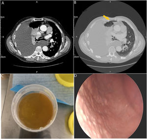 Panels A and B show the chest computed tomography scan demonstrating a large pleural effusion with a small apical pneumothorax (arrow) with no evidence of pleural thickening. Panel C shows the opaque deep yellow pleural aspirate. Panel D shows thoracoscopic view of diffuse micro nodularity of the parietal pleura.