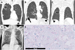 (A–C) The computed tomography revealed newly developed cavitary lesions in right upper and right lower lobes and pre-existing unchanged nodules (arrowheads). (D) The chest radiography showed corresponding cavitary lesions in right lung field. (E) The histopathologic finding in the wedged lung tissue (arrow in B) was extensive tissue necrosis with the presence of numerous acid-fast bacilli but no granuloma.