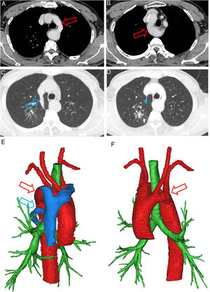 Images A, B, E and F show the existence of the double aortic arch (red arrow). Images C and D show the azygos vein (blue arrow) and the azygos fissure (asterisk).