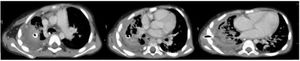 Necrotizing pneumonia in right upper lobe and chest tube placement.